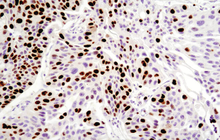 Cell Viability 9449 Ki 67 IHC Immunohistochemistry human breast carcinoma