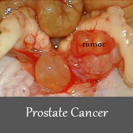 Prostate cancer 1