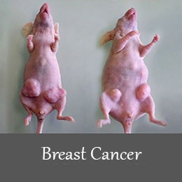 breast cancer 1