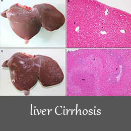 liver Cirrhosis 1