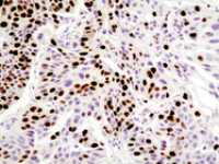 Cell-Viability_9449_Ki-67_IHC_Immunohistochemistry_human-breast-carcinoma